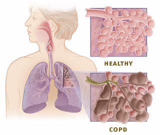 COPD A Serious Health Concern